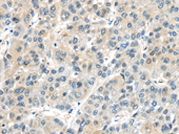 Immunohistochemical analysis of paraffin-embedded Human liver cancer tissue using #43102 at dilution 1/25,