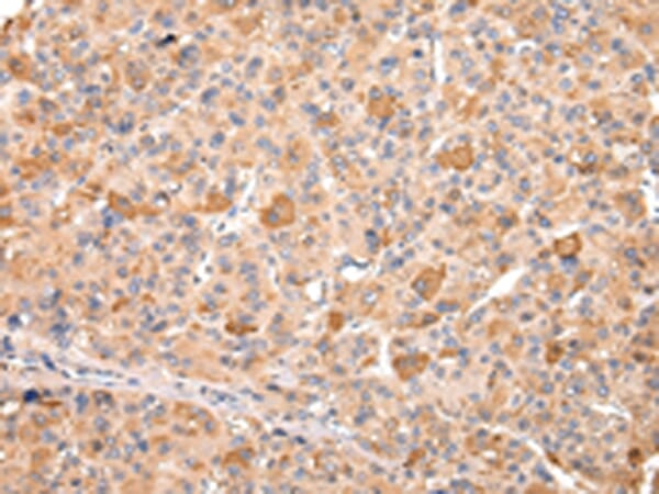 Immunohistochemical analysis of paraffin-embedded Human liver cancer tissue using #43107 at dilution 1/20.