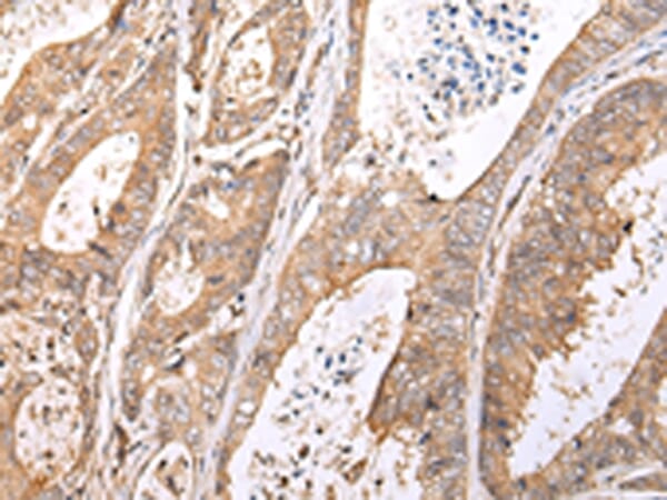 Immunohistochemical analysis of paraffin-embedded Human colorectal cancer tissue using #43201 at dilution 1/20.