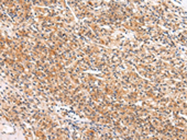 Immunohistochemical analysis of paraffin-embedded Human prostate cancer tissue using #43216 at dilution 1/20,