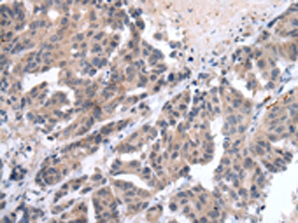 Immunohistochemical analysis of paraffin-embedded Human breast cancer tissue using #43245 at dilution 1/20.