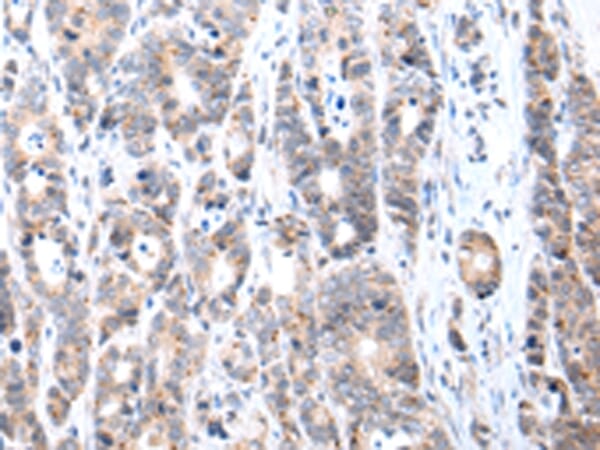 Immunohistochemical analysis of paraffin-embedded Human gastric cancer tissue using #43245 at dilution 1/20.