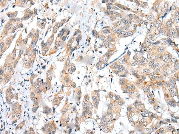 Immunohistochemical analysis of paraffin-embedded Human breast cancer tissue using #43370 at dilution 1/25,