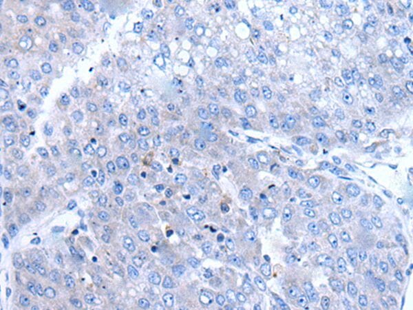 The image is immunohistochemistry of paraffin-embedded Human liver cancer tissue using BTG4 Antibody at dilution 1/100. (Original magnification: x200)