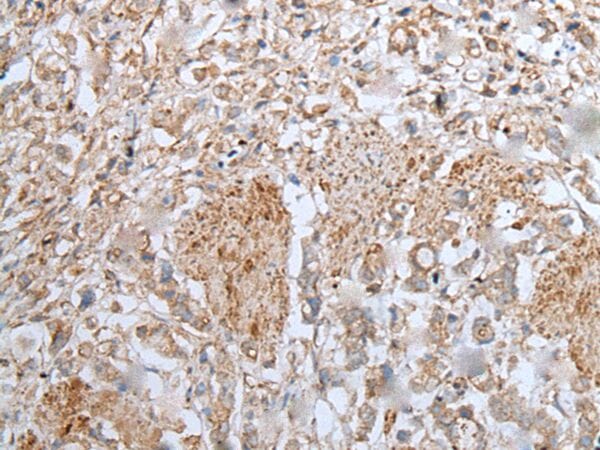 The image on the left is immunohistochemistry of paraffin-embedded Human gastric cancer tissue using UBA6 Antibody at dilution 1/30, on the right is treated with fusion protein. (Original magnification: x200)