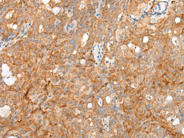 The image on the left is immunohistochemistry of paraffin-embedded Human ovarian cancer tissue using SDC2 Antibody at dilution 1/20, on the right is treated with synthetic peptide. (Original magnification: x200)