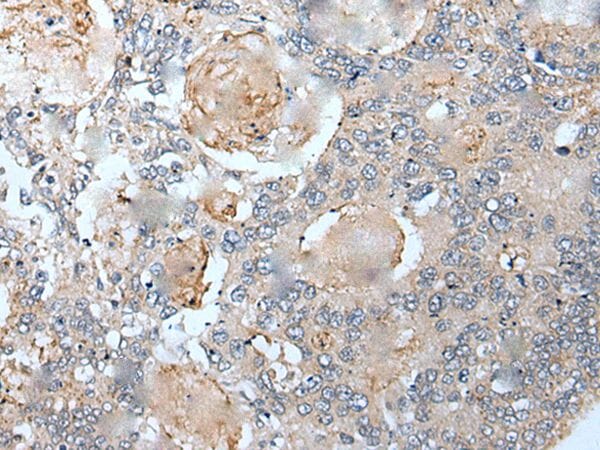 The image on the left is immunohistochemistry of paraffin-embedded Human colorectal cancer tissue using VEZT Antibody at dilution 1/30, on the right is treated with synthetic peptide. (Original magnification: x200)