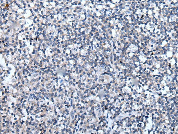 The image on the left is immunohistochemistry of paraffin-embedded Human tonsil tissue using VEZT Antibody at dilution 1/30, on the right is treated with synthetic peptide. (Original magnification: x200)