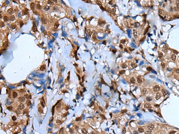 The image on the left is immunohistochemistry of paraffin-embedded Human breast cancer tissue using UNCX Antibody at dilution 1/25, on the right is treated with synthetic peptide. (Original magnification: x200)
