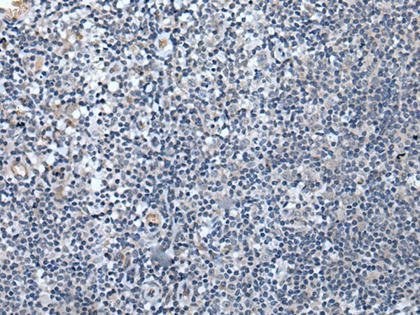The image on the left is immunohistochemistry of paraffin-embedded Human tonsil tissue using SPTB Antibody at dilution 1/40, on the right is treated with synthetic peptide. (Original magnification: x200)
