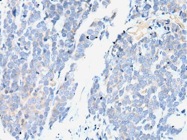 The image on the left is immunohistochemistry of paraffin-embedded Human thyroid cancer tissue using SMC2 Antibody at dilution 1/25, on the right is treated with synthetic peptide. (Original magnification: x200)