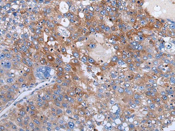 The image on the left is immunohistochemistry of paraffin-embedded Human liver cancer tissue using WEE2 Antibody at dilution 1/40, on the right is treated with synthetic peptide. (Original magnification: x200)