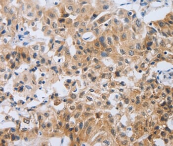 Immunohistochemical analysis of paraffin-embedded Human lung cancer tissue using #37179 at dilution 1/80.
