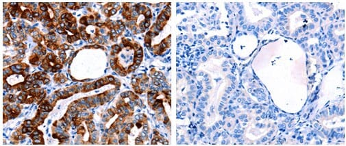 The image on the left is immunohistochemistry of paraffin-embedded Human thyroid cancer tissue using 31059 (CLEC4D Antibody) at dilution 1/50, on the right is treated with the fusion protein.