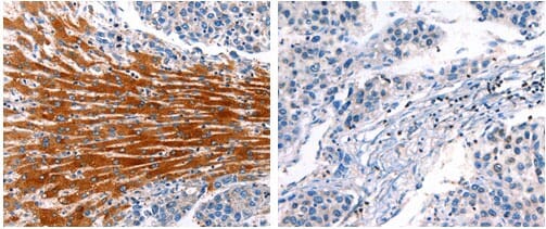 The image on the left is immunohistochemistry of paraffin-embedded Human liver cancer tissue using 31065 (CYP1A1 Antibody) at dilution 1/25, on the right is treated with the fusion protein.