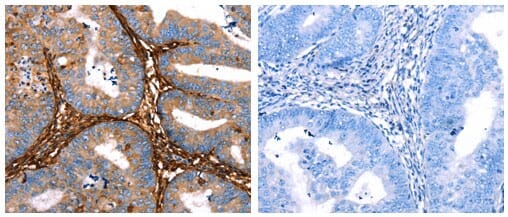 The image on the left is immunohistochemistry of paraffin-embedded Human cervical cancer tissue using 31074 (LGALS1 Antibody) at dilution 1/25, on the right is treated with the fusion protein.
