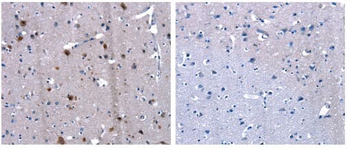 The image on the left is immunohistochemistry of paraffin-embedded Human brain cancer tissue using 31075 (LGALS2 Antibody) at dilution 1/13, on the right is treated with the fusion protein.