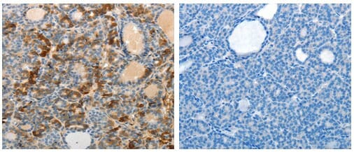 The image on the left is immunohistochemistry of paraffin-embedded human thyroid cancer tissue using 31095 (MAD2L1 Antibody) at dilution 1/25, on the right is treated with the fusion protein.
