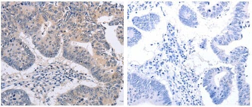 The image on the left is immunohistochemistry of paraffin-embedded human colon cancer tissue using 31096 (FBXO32 Antibody) at dilution 1/15, on the right is treated with the fusion protein.
