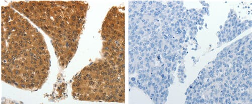 The image on the left is immunohistochemistry of paraffin-embedded human liver cancer tissue using 31120 (PSMD14 Antibody) at dilution 1/20, on the right is treated with the fusion protein.