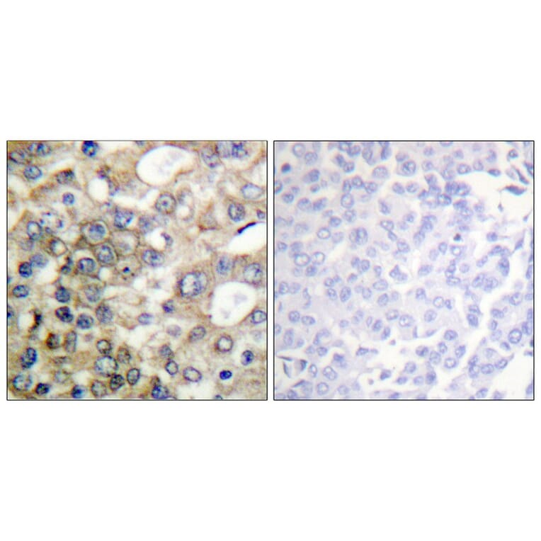 Immunohistochemistry - CD227/MUC1 (Phospho-Tyr1229) Antibody from Signalway Antibody (11707) - Antibodies.com