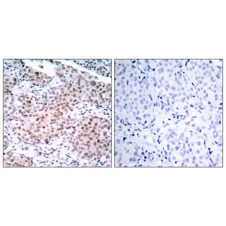 Immunohistochemistry - Estrogen Receptor-a (Phospho-Ser104) Antibody from Signalway Antibody - Antibodies.com
