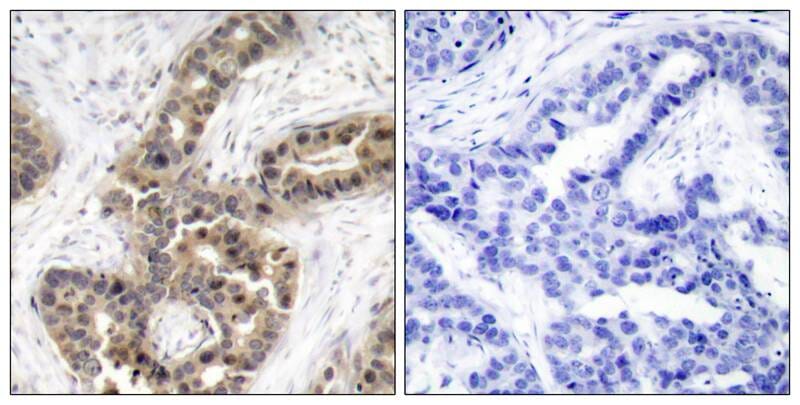 Immunohistochemical analysis of paraffin-embedded human breast carcinoma tissue using p21Cip1 (Phospho-Thr145) Antibody #11206 (left) or the same antibody preincubated with blocking peptide (right).