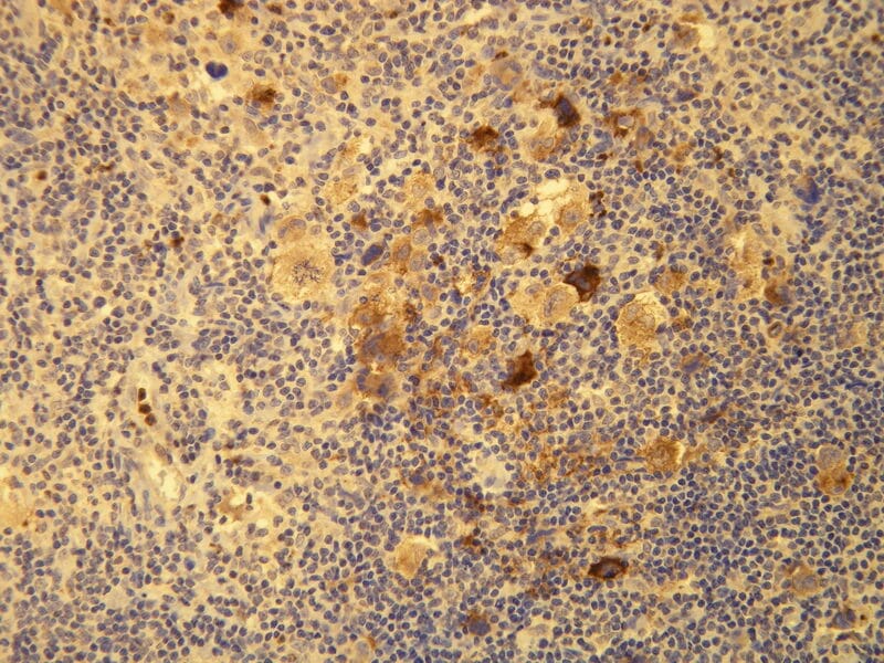 HRS cells of the classical Hodgkin Lymphoma showing cytoplasmic expression of the EBV LMP-1 protein. Formalin fixed, paraffin embedded human tissue (4µm section) stained with Anti-EBV LMP-1 Antibody (A8206).