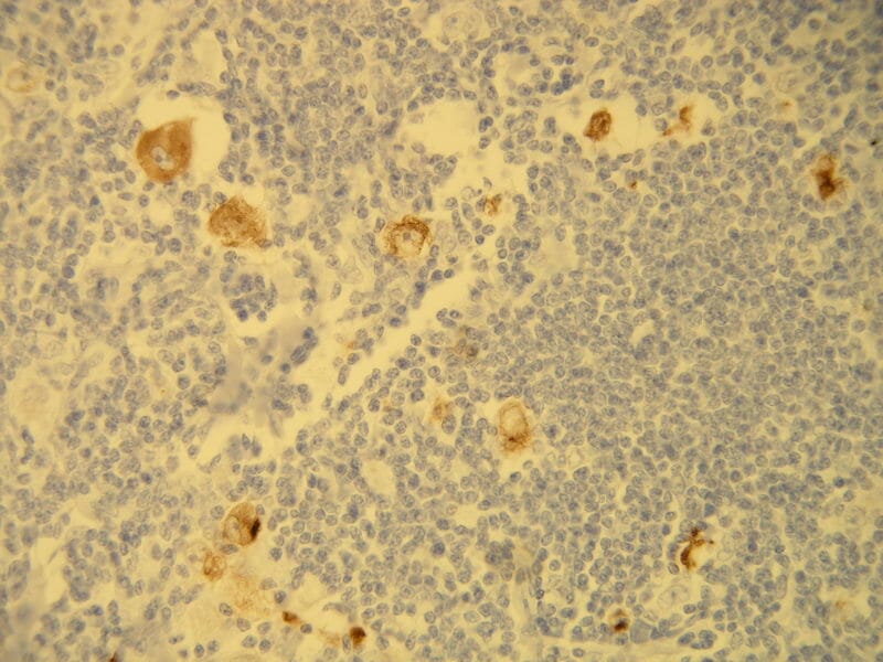 HRS cells of the classical Hodgkin Lymphoma showing cytoplasmic expression of the EBV LMP-1 protein. Formalin fixed, paraffin embedded human tissue (4µm section) stained with Anti-EBV LMP-1 Antibody (A8207).