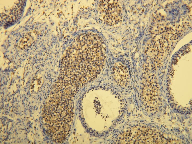 Membranous CD117 positivity in the classical seminoma. Formalin fixed, paraffin embedded human tissues (4µm sections) stained with Anti-CD117 Antibody (A8208).