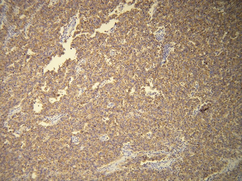 Membranous CD117 positivity in the classical seminoma. Formalin fixed, paraffin embedded human tissues (4µm sections) stained with Anti-CD117 Antibody (A8208).