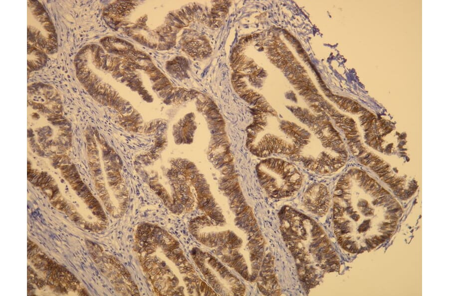 Immunohistochemistry - Anti-CerbB2 Antibody - Antibodies.com (A8216)