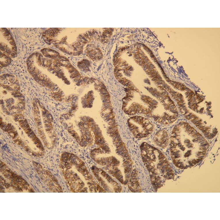 Immunohistochemistry - Anti-CerbB2 Antibody - Antibodies.com (A8216)