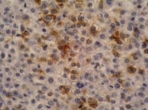 Immunohistochemistry staining of hepatocellular carcinoma (fetal liver; paraffin-embedded sections) with Anti-alpha Fetoprotein Antibody (A85534).
