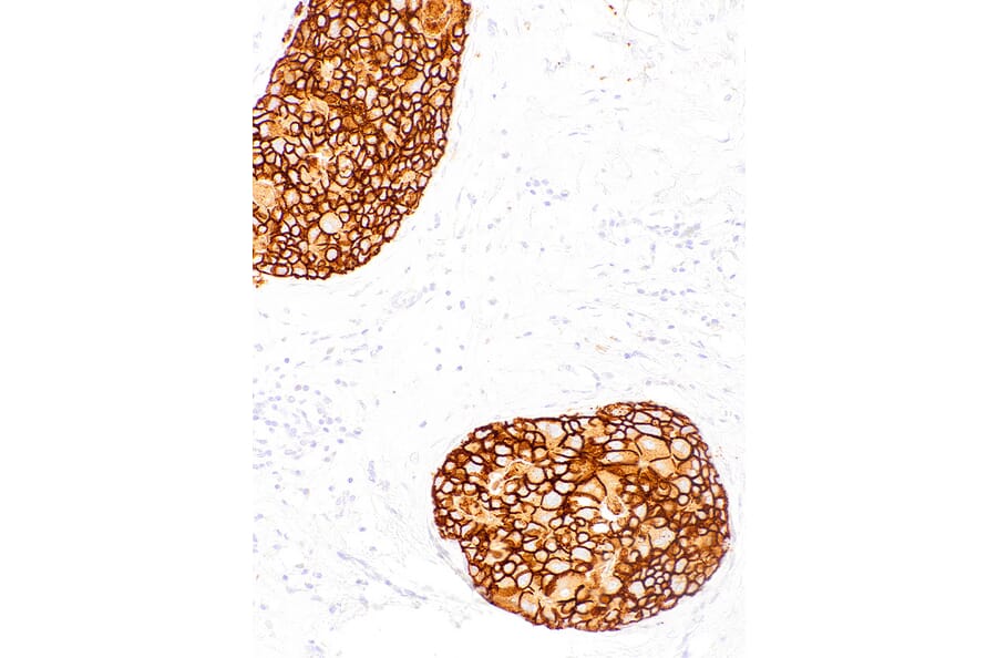 Immunohistochemistry - Anti-ErbB2/HER2 Antibody [IHC002] (A86897) - Antibodies.com