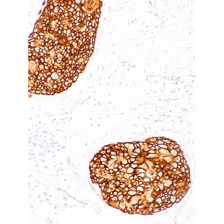 Immunohistochemistry - Anti-ErbB2/HER2 Antibody [IHC002] (A86897) - Antibodies.com
