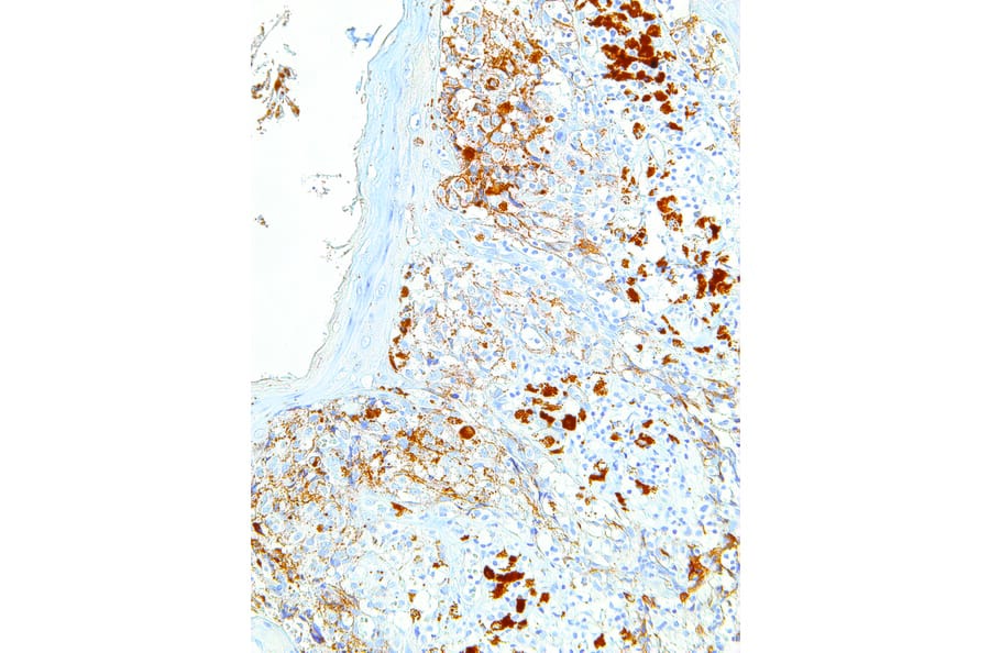 Immunohistochemistry - Anti-Melanoma Associated Antigen Antibody [IHC062] (A86898) - Antibodies.com