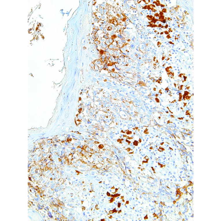 Immunohistochemistry - Anti-Melanoma Associated Antigen Antibody [IHC062] (A86898) - Antibodies.com