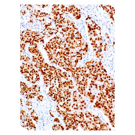Immunohistochemistry - Anti-PAX8 Antibody [IHC008] (A86902) - Antibodies.com