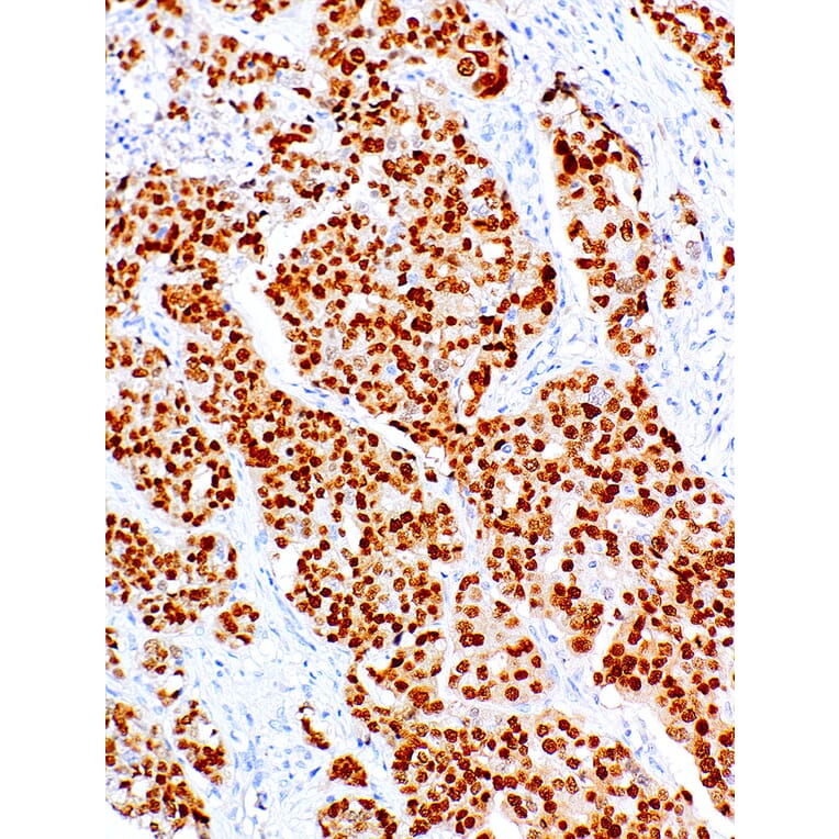 Immunohistochemistry - Anti-PAX8 Antibody [IHC008] (A86902) - Antibodies.com