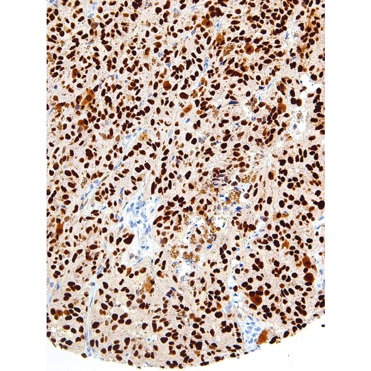 Immunohistochemistry - Anti-SOX10 Antibody [IHC010] (A86907) - Antibodies.com
