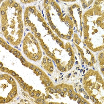Immunohistochemistry of paraffin-embedded human kidney cancer using µgT1A4 antibody (A5549) at dilution of 1:200 (40x lens).