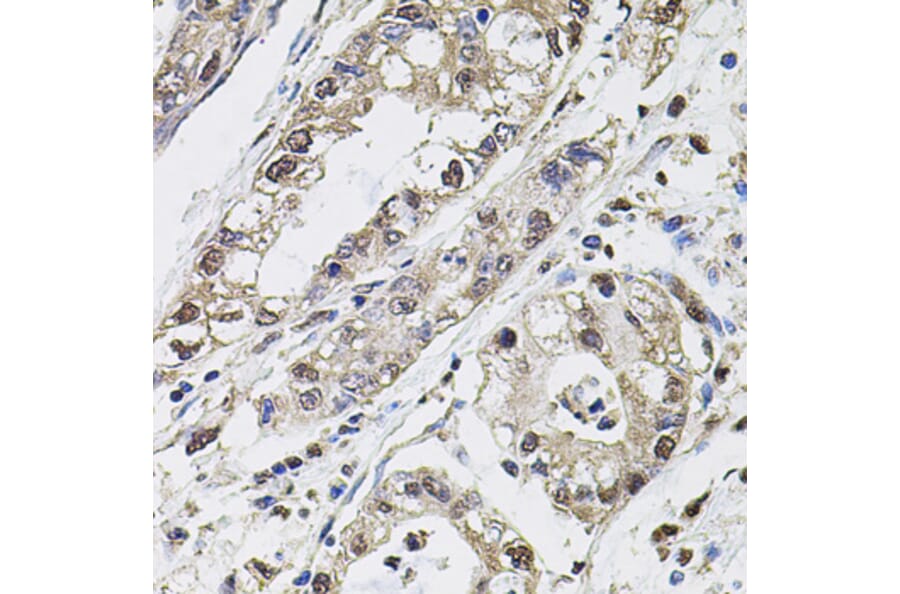 Immunohistochemistry - Anti-Carbonic Anhydrase 9/CA9 Antibody (A90618) - Antibodies.com