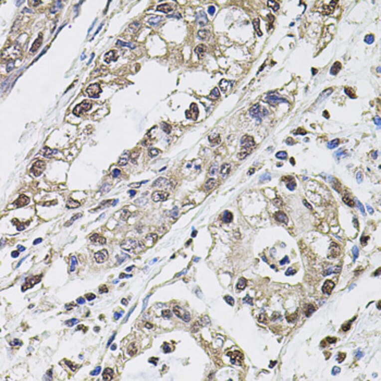 Immunohistochemistry - Anti-Carbonic Anhydrase 9/CA9 Antibody (A90618) - Antibodies.com
