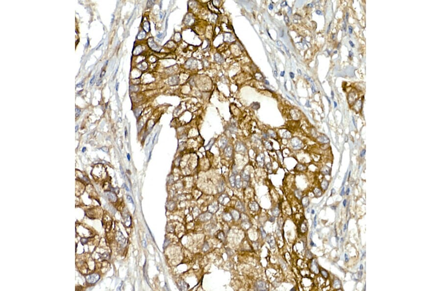 Immunohistochemistry - Anti-Mesothelin Antibody (A92393) - Antibodies.com