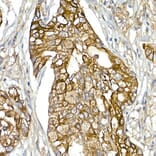 Immunohistochemistry - Anti-Mesothelin Antibody (A92393) - Antibodies.com