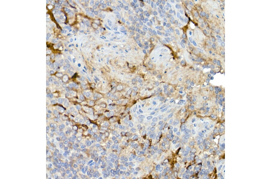 Immunohistochemistry - Anti-Mesothelin Antibody (A92393) - Antibodies.com