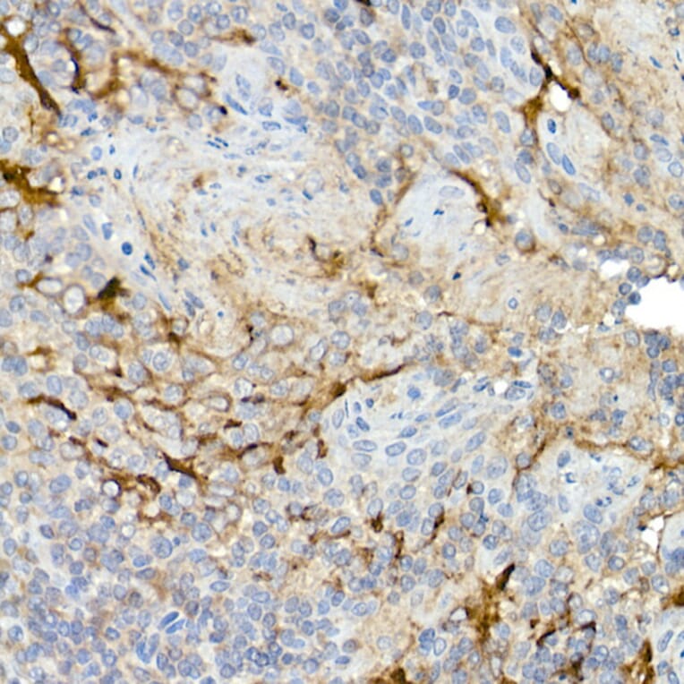 Immunohistochemistry - Anti-Mesothelin Antibody (A92393) - Antibodies.com