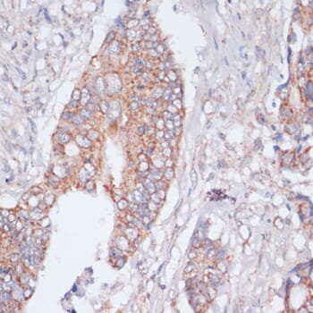 Immunohistochemistry of paraffin-embedded human colon cancer using Anti-MBTPS1 Antibody (A13379) at dilution of 1:100 (40x lens).