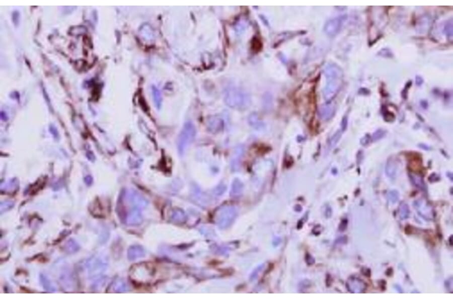 Immunohistochemical analysis - breast cancer - Antibodies.com